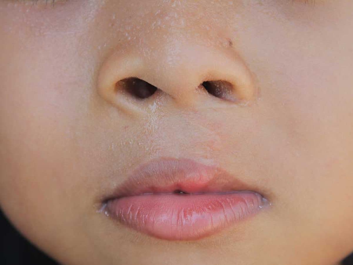 Manage Lip and Jaw Development