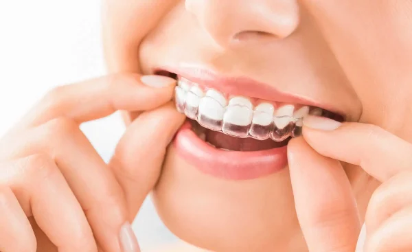 Invisalign or Clear Aligners